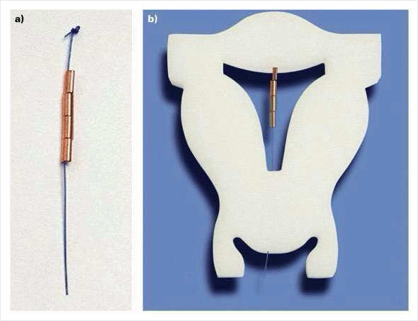 GyneFix Boncuklu Spiral