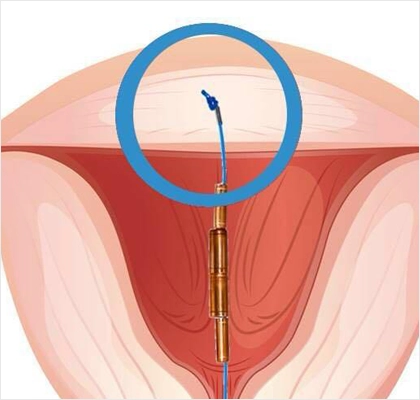 GyneFix Spiral