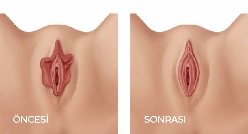 Labioplasti Öncesi Sonrası