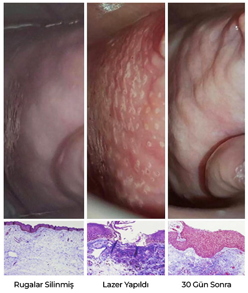 Lazerle Vajina Daraltma