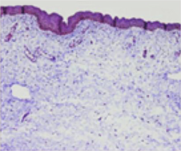 Vajina Lazer Öncesi