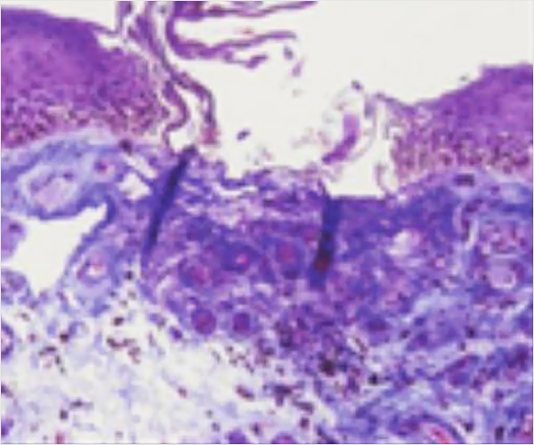 Vajina Lazer Sonrası