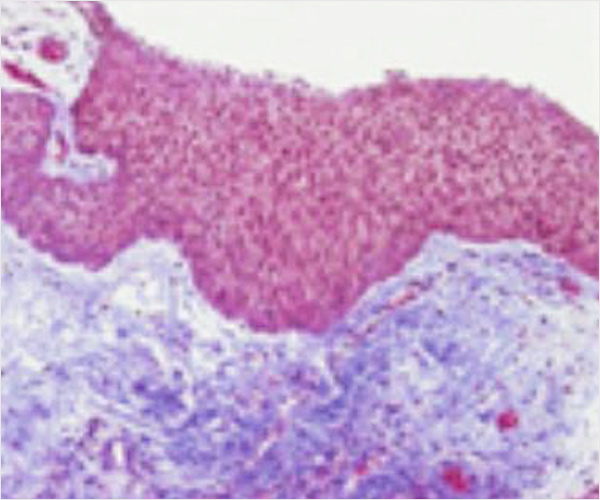 Lazerle Vajina Sıkılaştırma 1 Ay Sonra